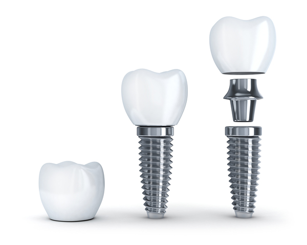 人工歯とアバットメント