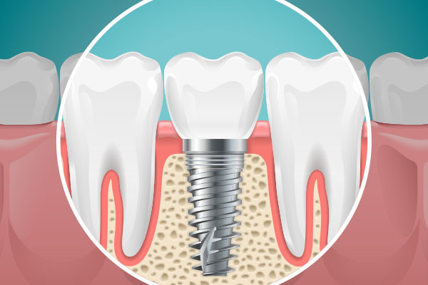 奥歯のインプラントの注意点